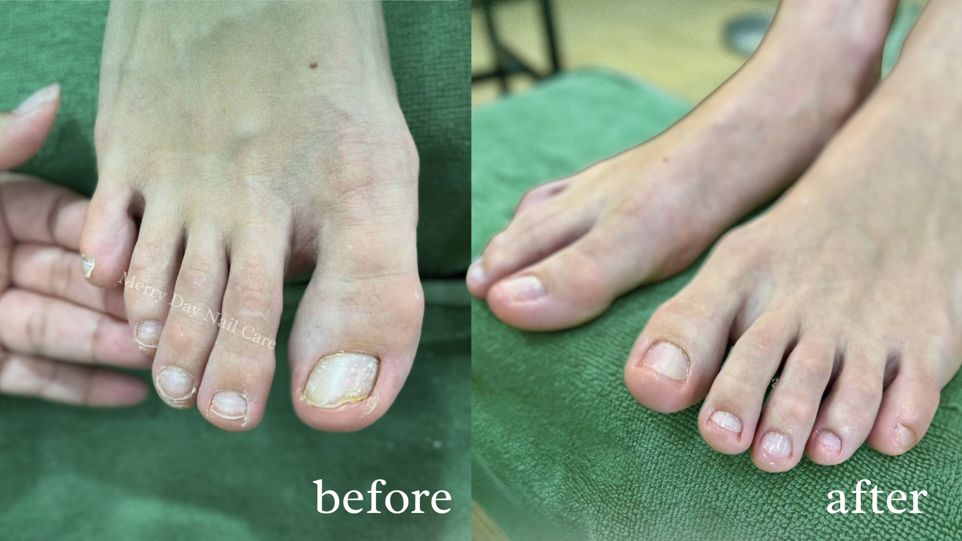 Why Do Nails Turn Yellow – and When Should You Start Caring?